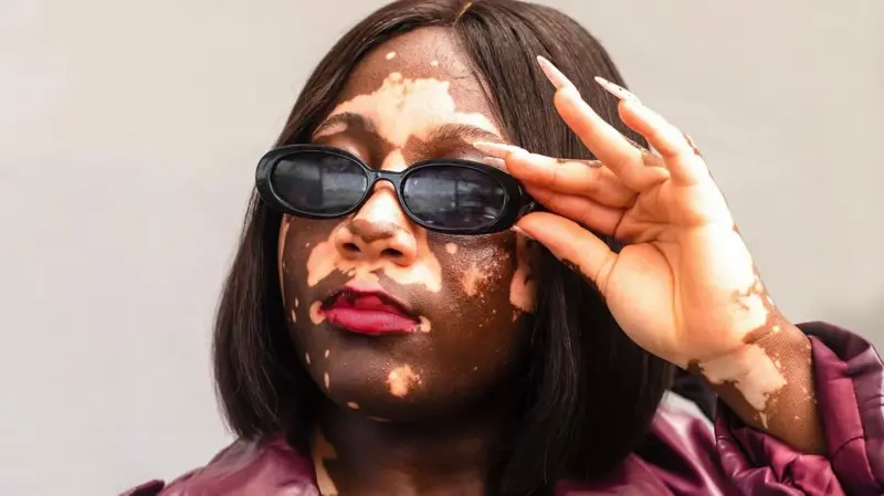Nigeria: ‘Embrace us, we’re just different’: Ghanaian vitiligo model Abigail Boateng speaks out against stigma